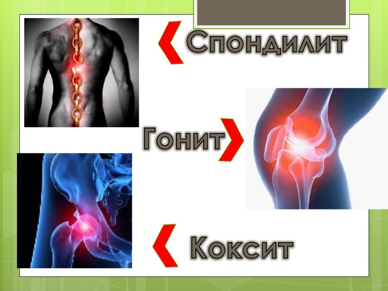 Спондилит Коксит Гонит